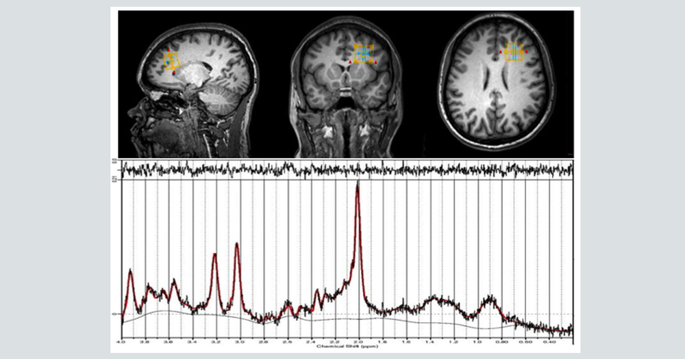 USP identifica alteração cerebral em mulheres com depressão pós-parto